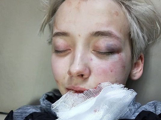 Ομάδα επτά ανδρών επιτέθηκε σε έφηβη λόγω ομοφοβίας στη Ρωσία