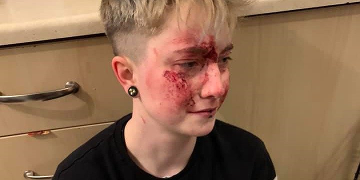 Αιματηρή ομοφοβική επίθεση σε 20χρονη λεσβία στην Αγγλία